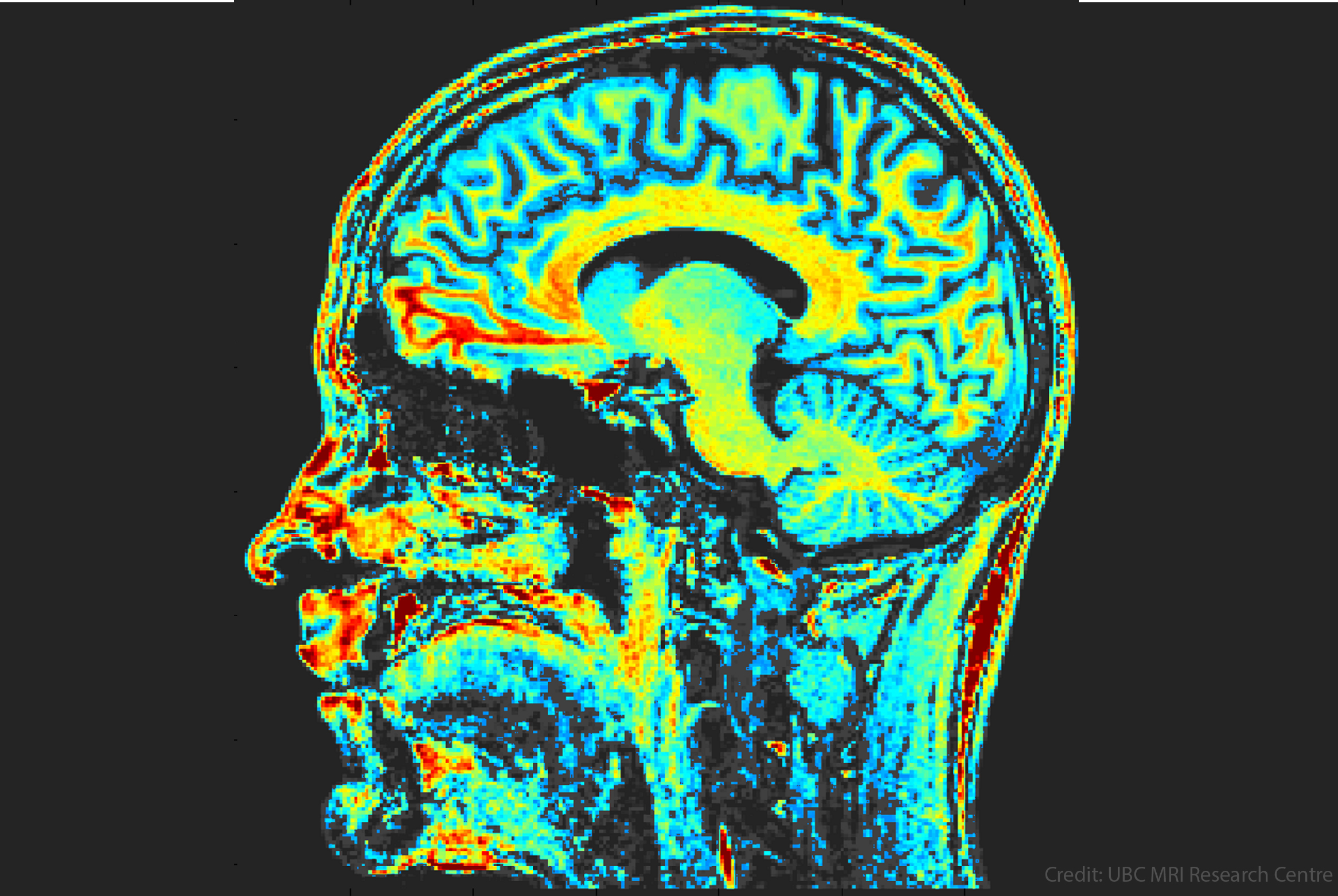 Kip Kinkle'S Brain: The Scan That Proves Everything - 89gt5kr