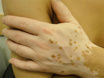Vejrtrækning Sociologi Har råd til Ask an expert: What causes white skin patches? | VCH Research Institute